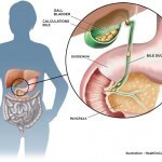 Explanation of where gall stones are located in the human body, and how haritaki helps them